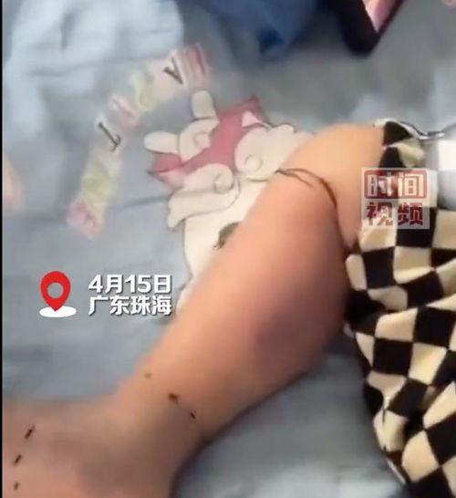 一岁男童遭女子强搂亲吻后发烧得水痘，警惕陌生接触风险
